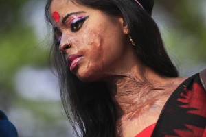 donna sfigurata con acido